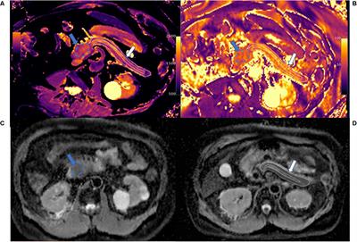 Multiparametric Mapping Magnetic Resonance Imaging of Pancreatic Disease